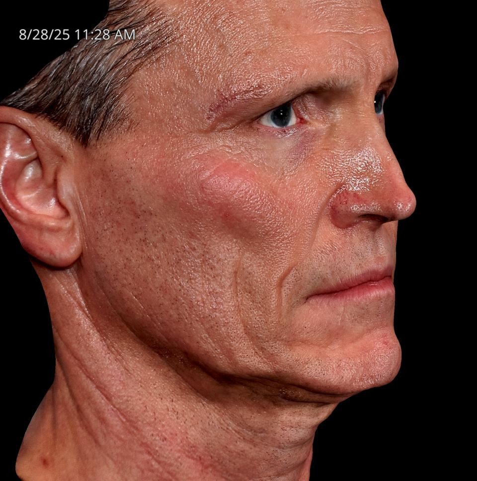 Before Image: Endo-One - right-front-oblique