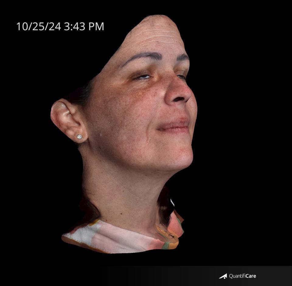 After Image: Melasma - right-front-oblique