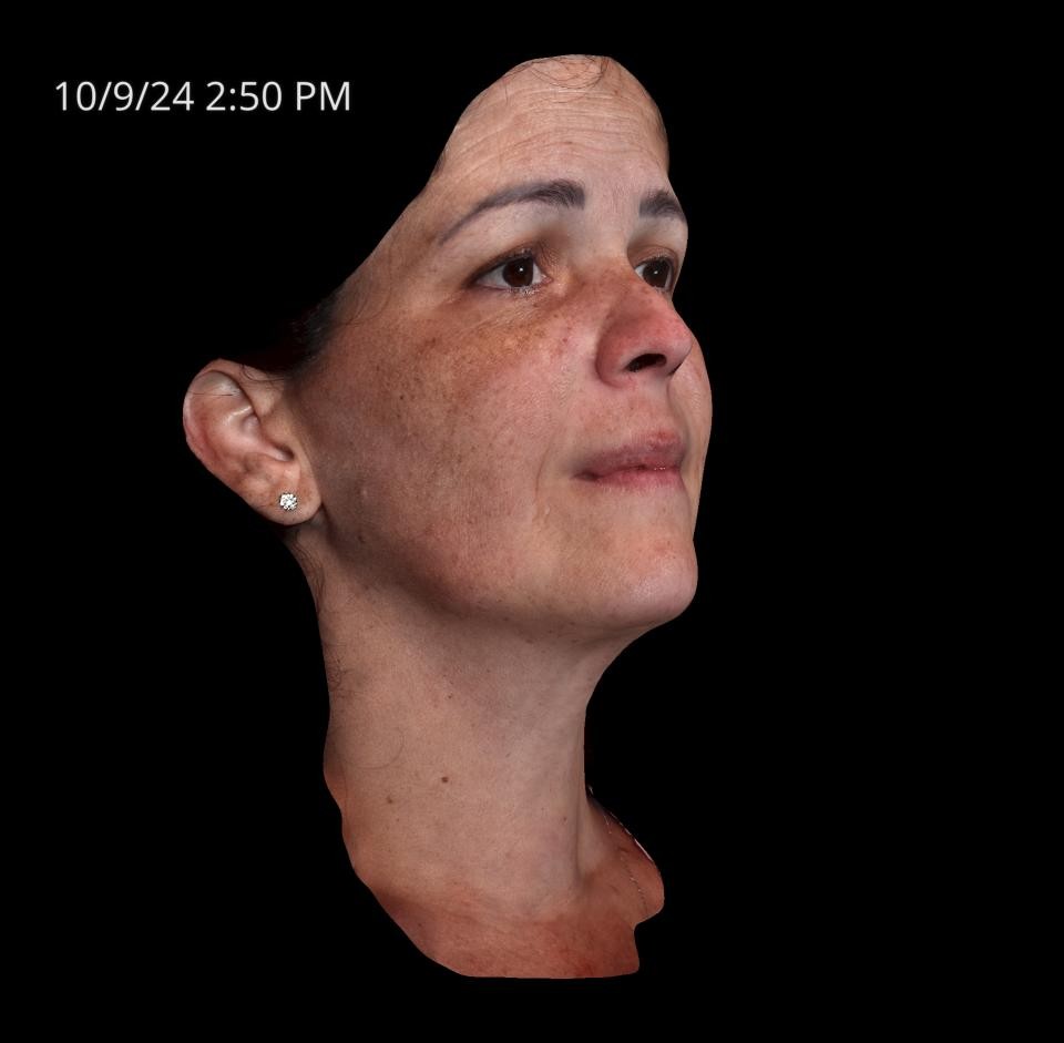 Before Image: Melasma - right-front-oblique