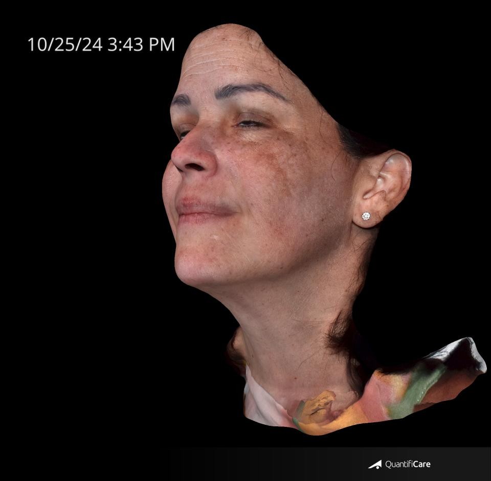 After Image: Melasma - left-front-oblique