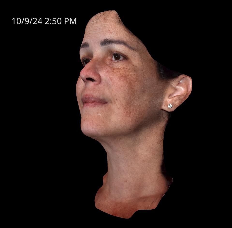 Before Image: Melasma - left-front-oblique