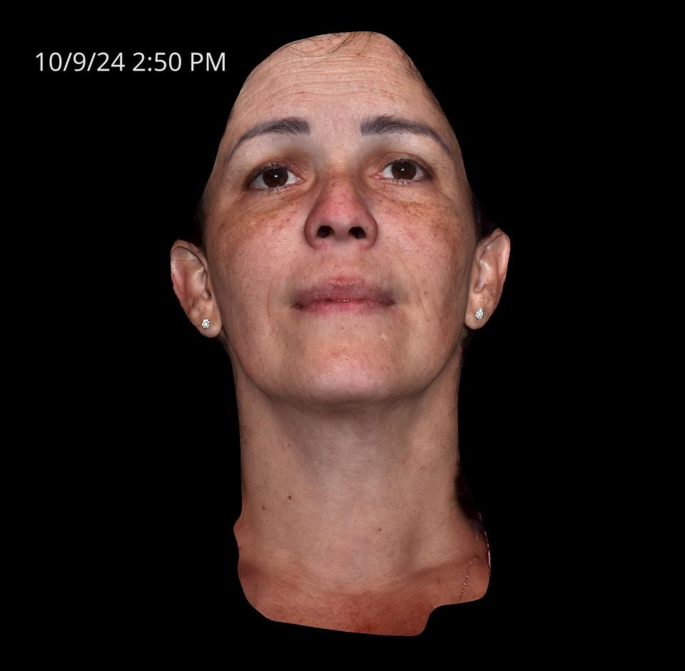 Before Image: Melasma - left-front-oblique