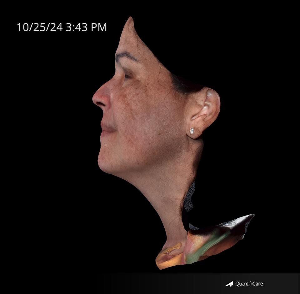 After Image: Melasma - left-side