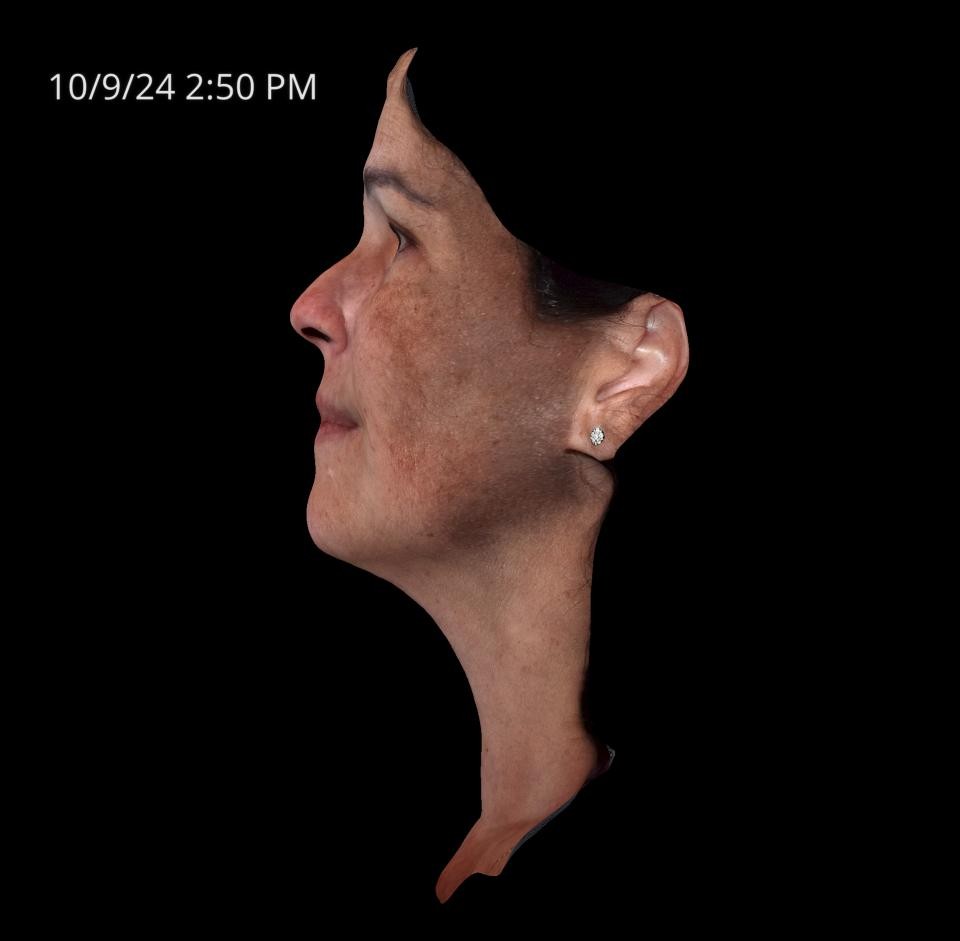 Before Image: Melasma - left-side