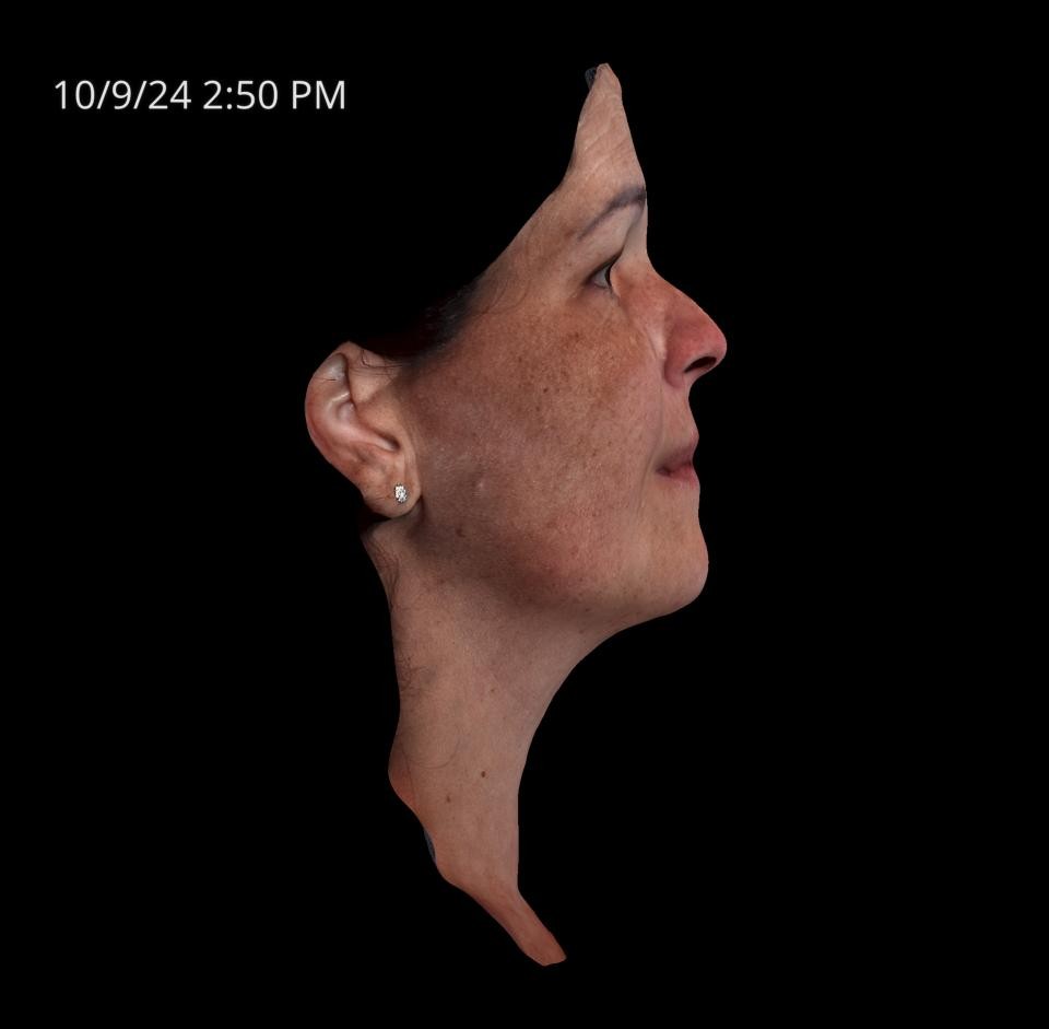 Before Image: Melasma - right-side