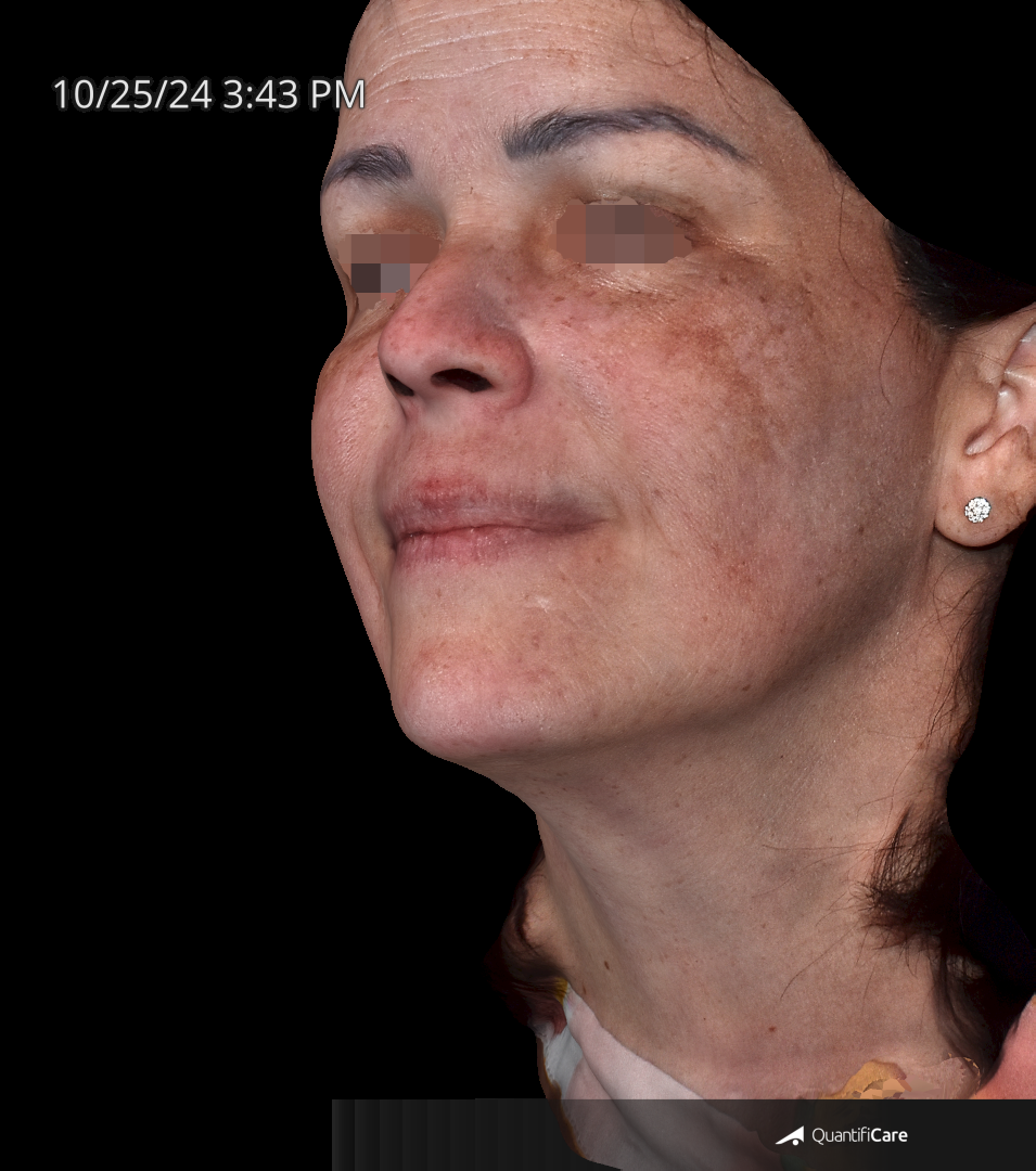After Image: Melasma - left-front-oblique