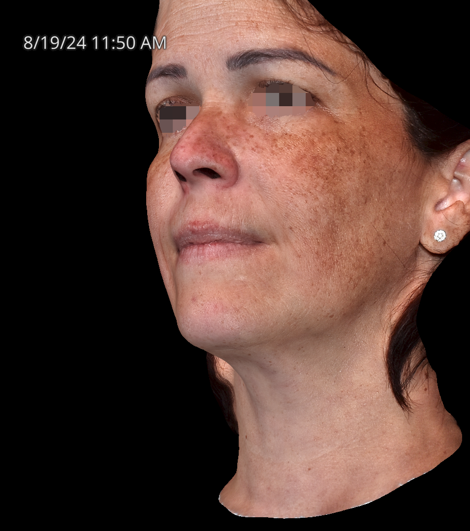 Before Image: Melasma - left-front-oblique