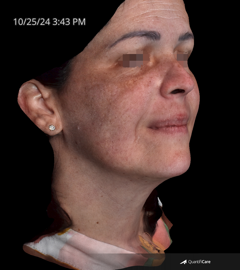 After Image: Melasma - right-front-oblique
