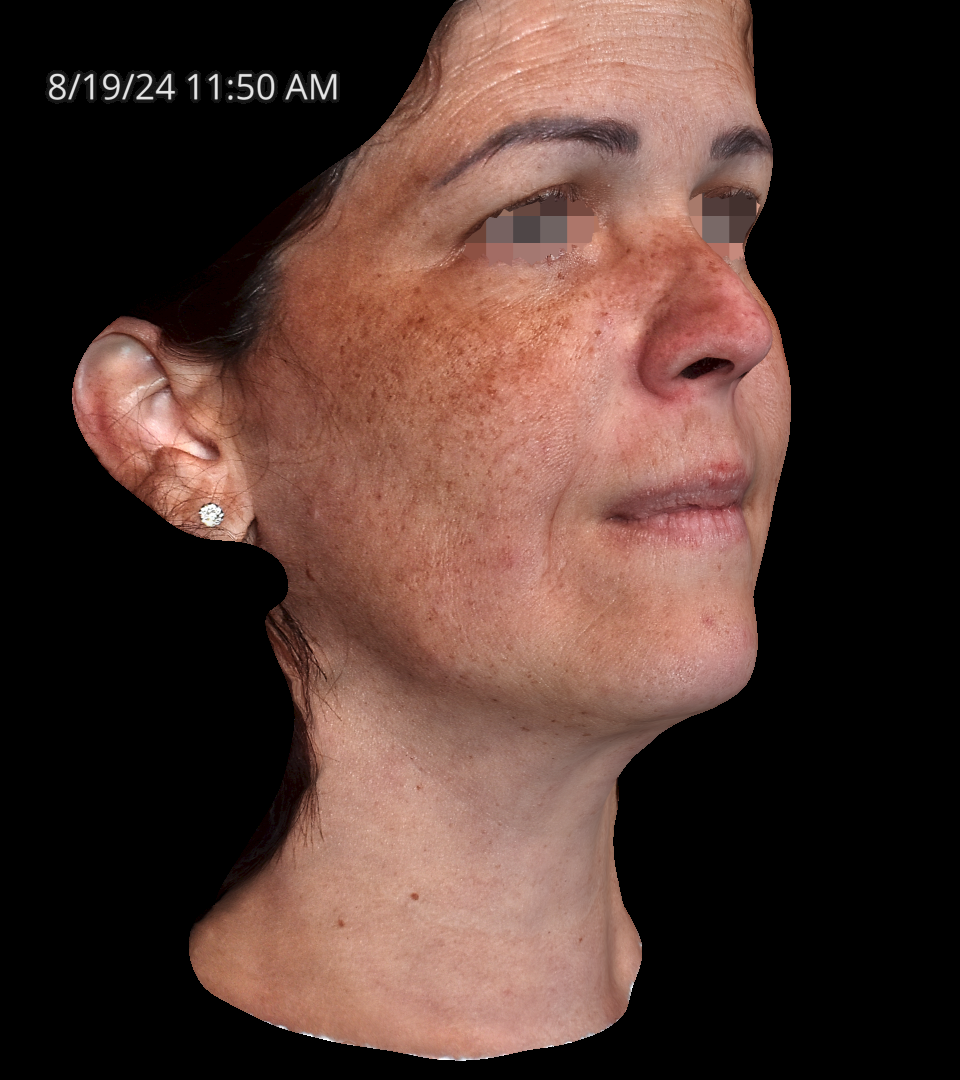 Before Image: Melasma - right-front-oblique