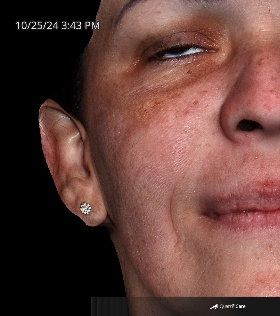 After Image: Melasma - front