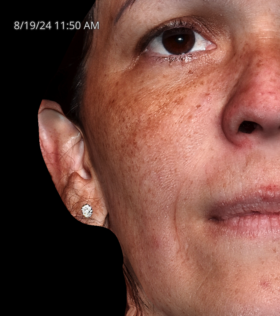 Before Image: Melasma - front