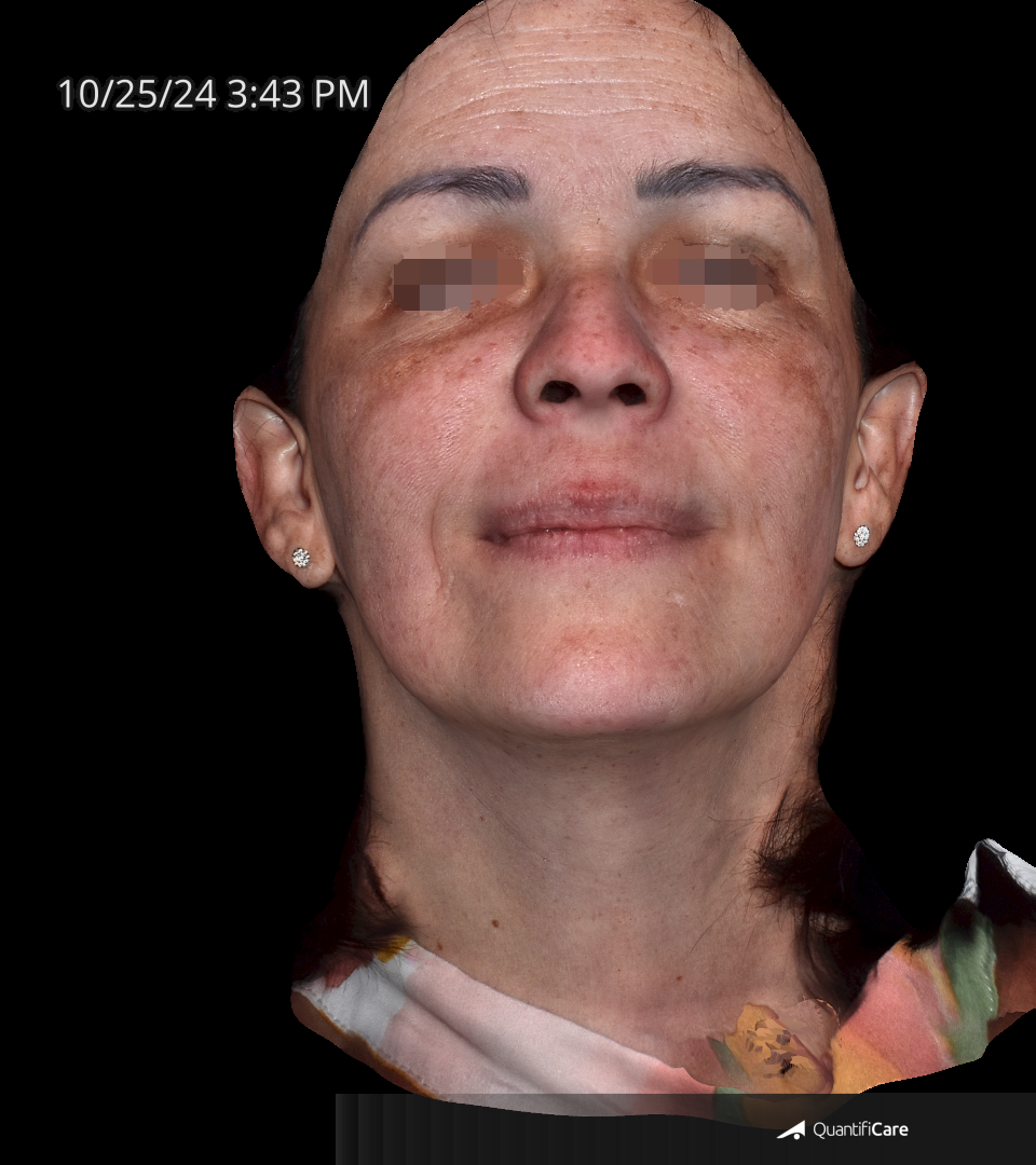 After Image: Melasma - front