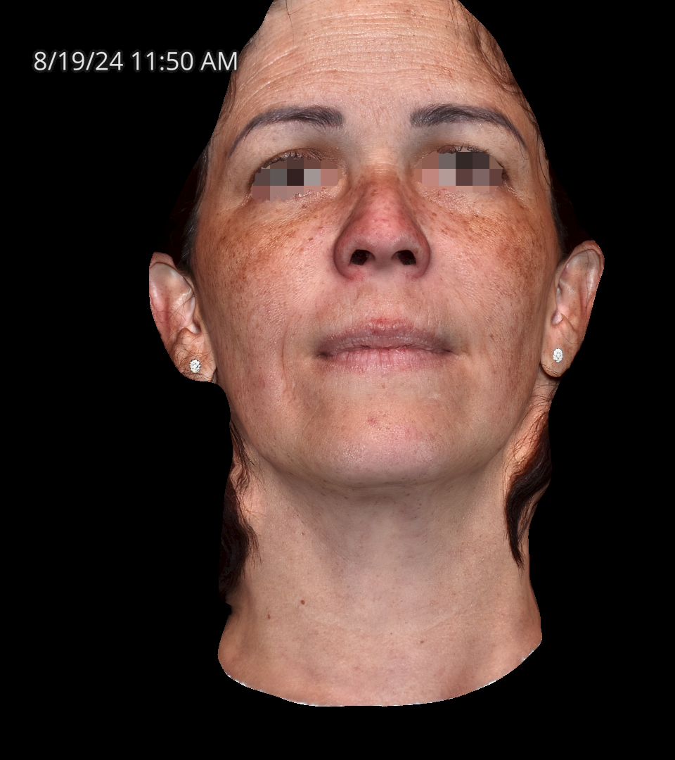 Before Image: Melasma - front