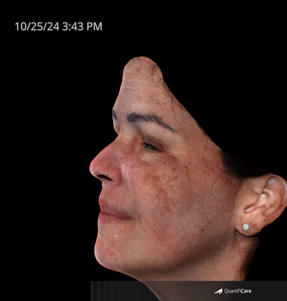 After Image: Melasma - left-side