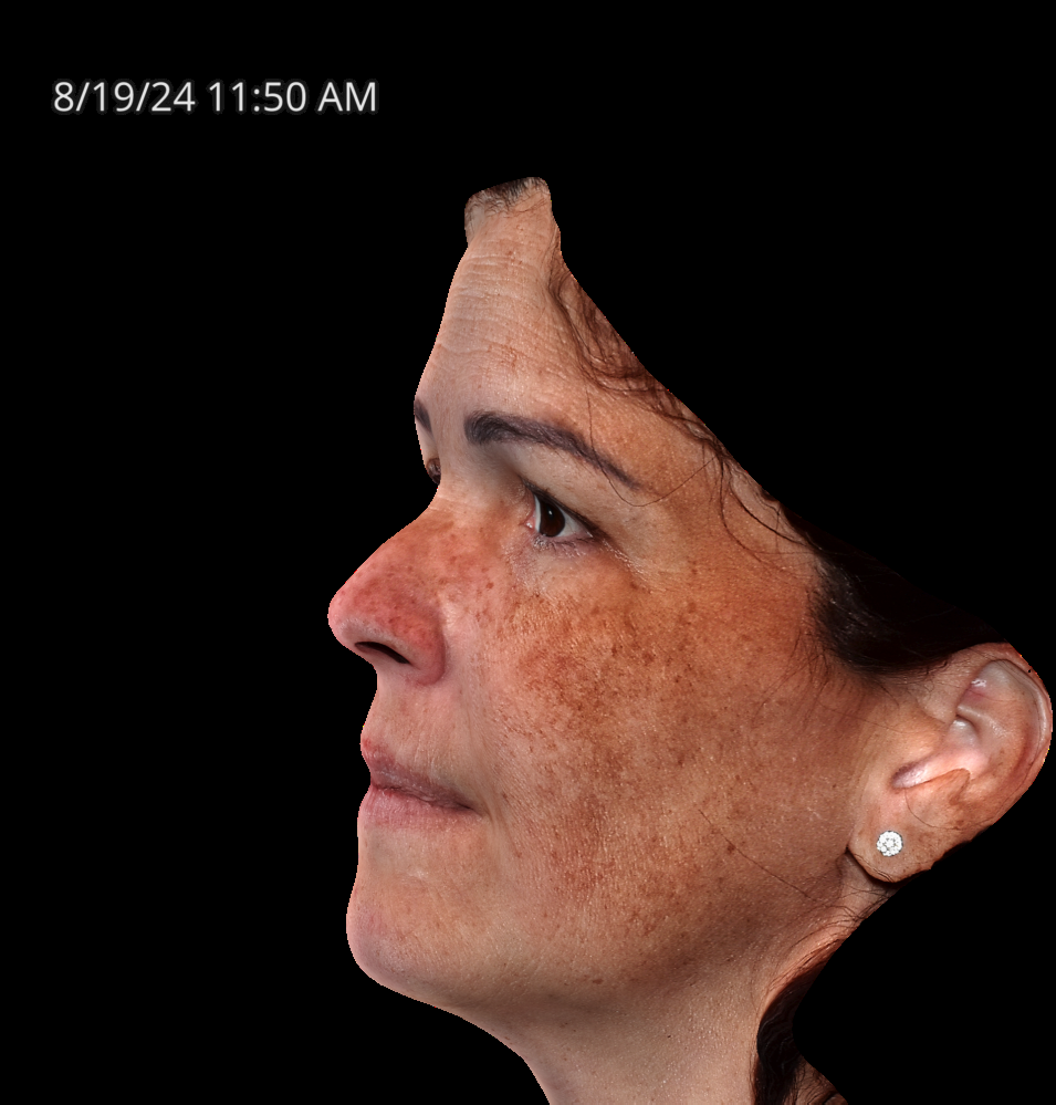 Before Image: Melasma - left-side
