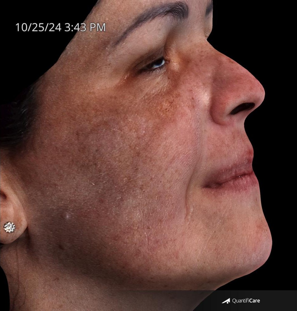 After Image: Melasma - right-side