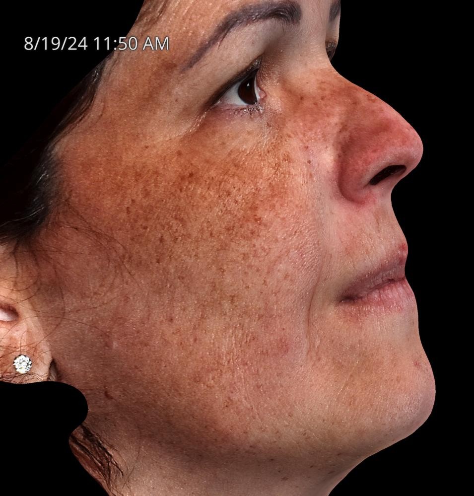 Before Image: Melasma - right-side