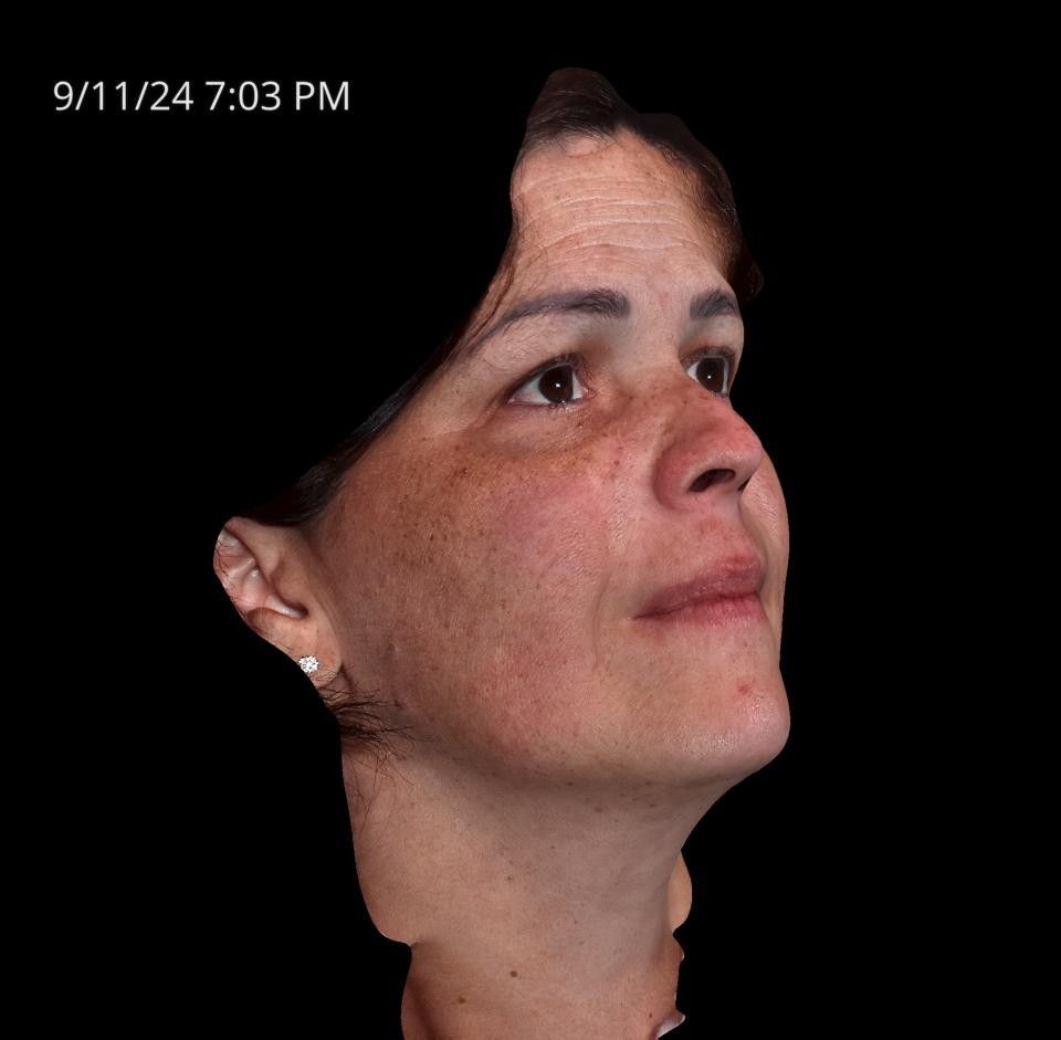 Before Image: Melasma - right-front-oblique