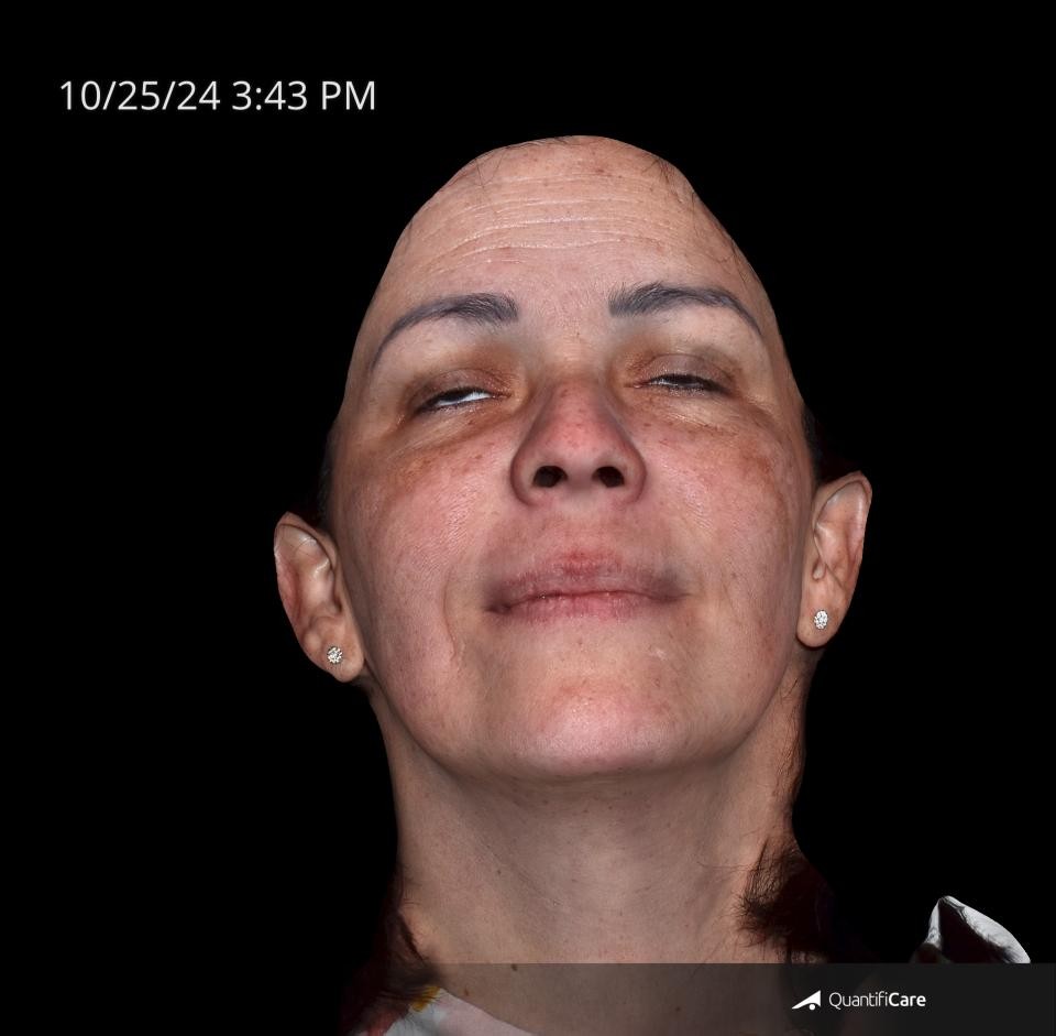 After Image: Melasma - front