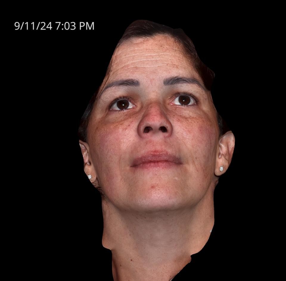 Before Image: Melasma - front