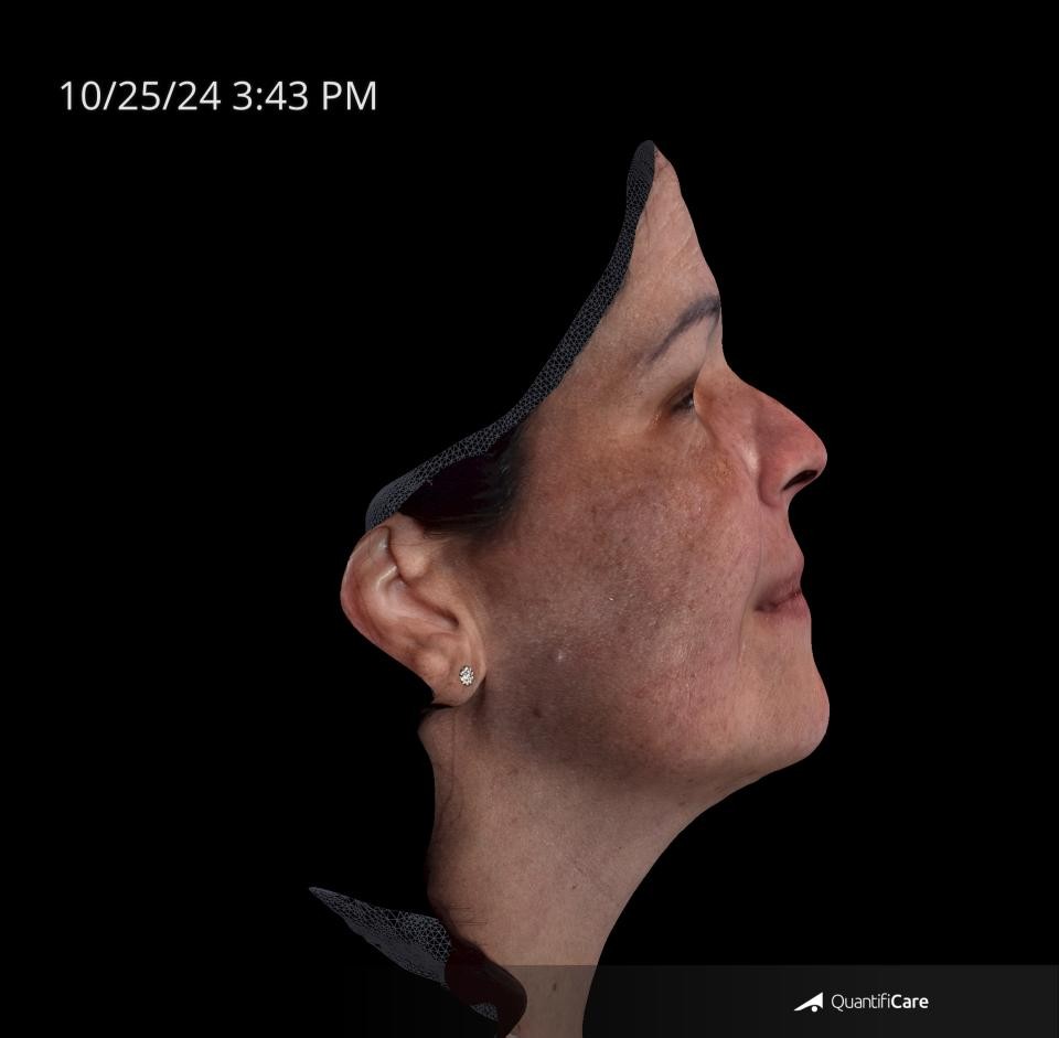 After Image: Melasma - right-side