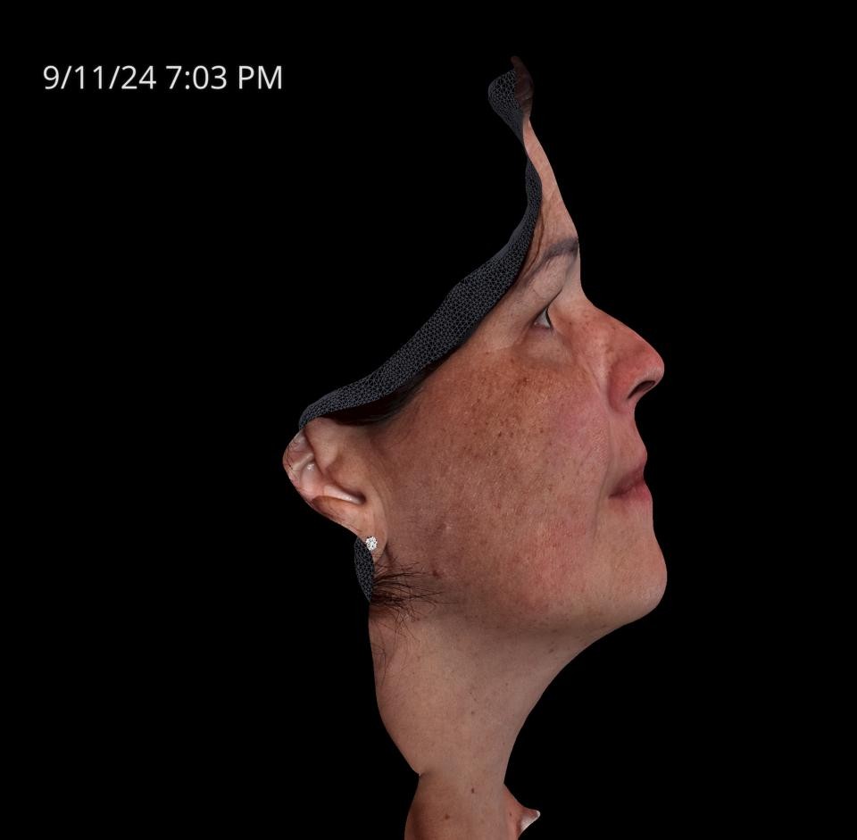 Before Image: Melasma - right-side