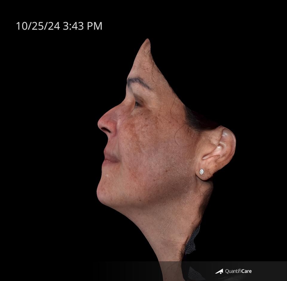 After Image: Melasma - left-side