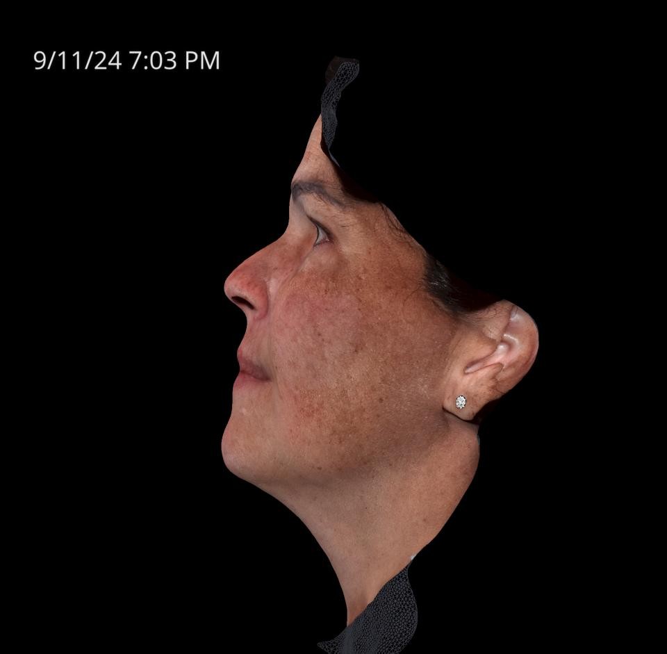 Before Image: Melasma - left-side