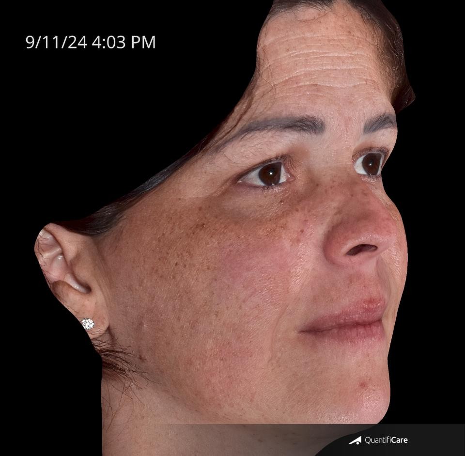 After Image: Melasma - right-front-oblique
