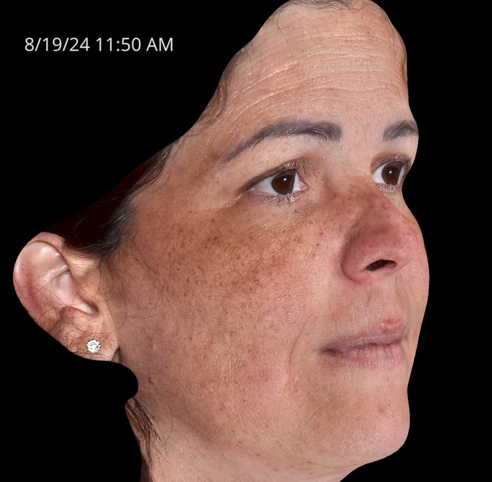 Before Image: Melasma - right-front-oblique