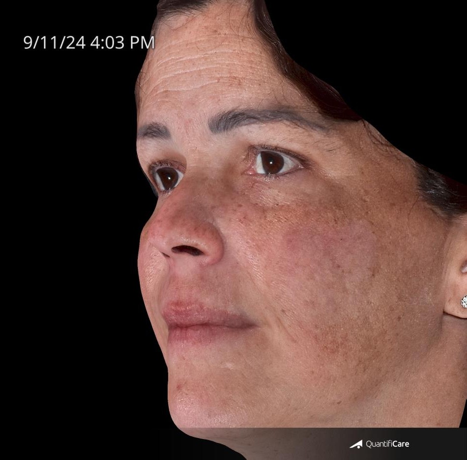 After Image: Melasma - left-front-oblique