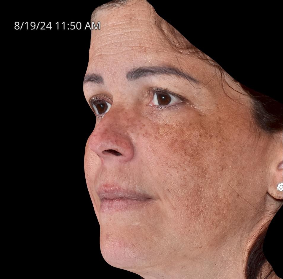 Before Image: Melasma - left-front-oblique