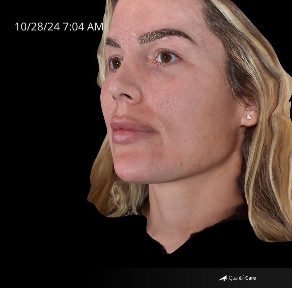 After Image: Rosacea - left-front-oblique