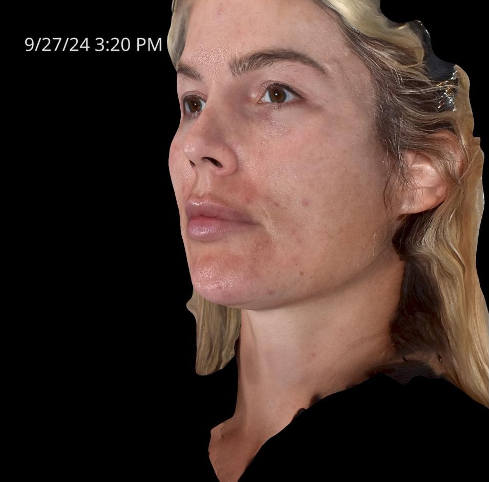 Before Image: Rosacea - left-front-oblique