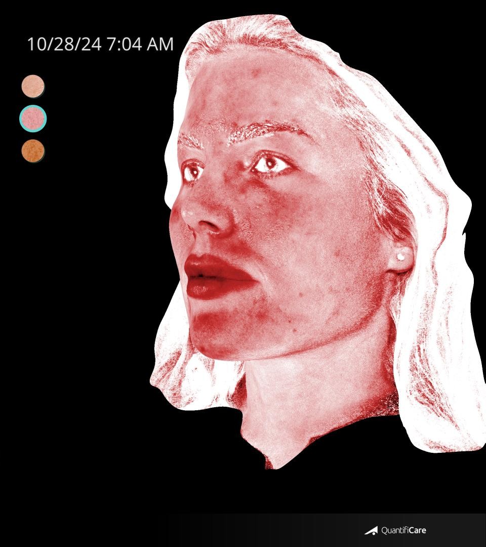 After Image: Rosacea - left-front-oblique