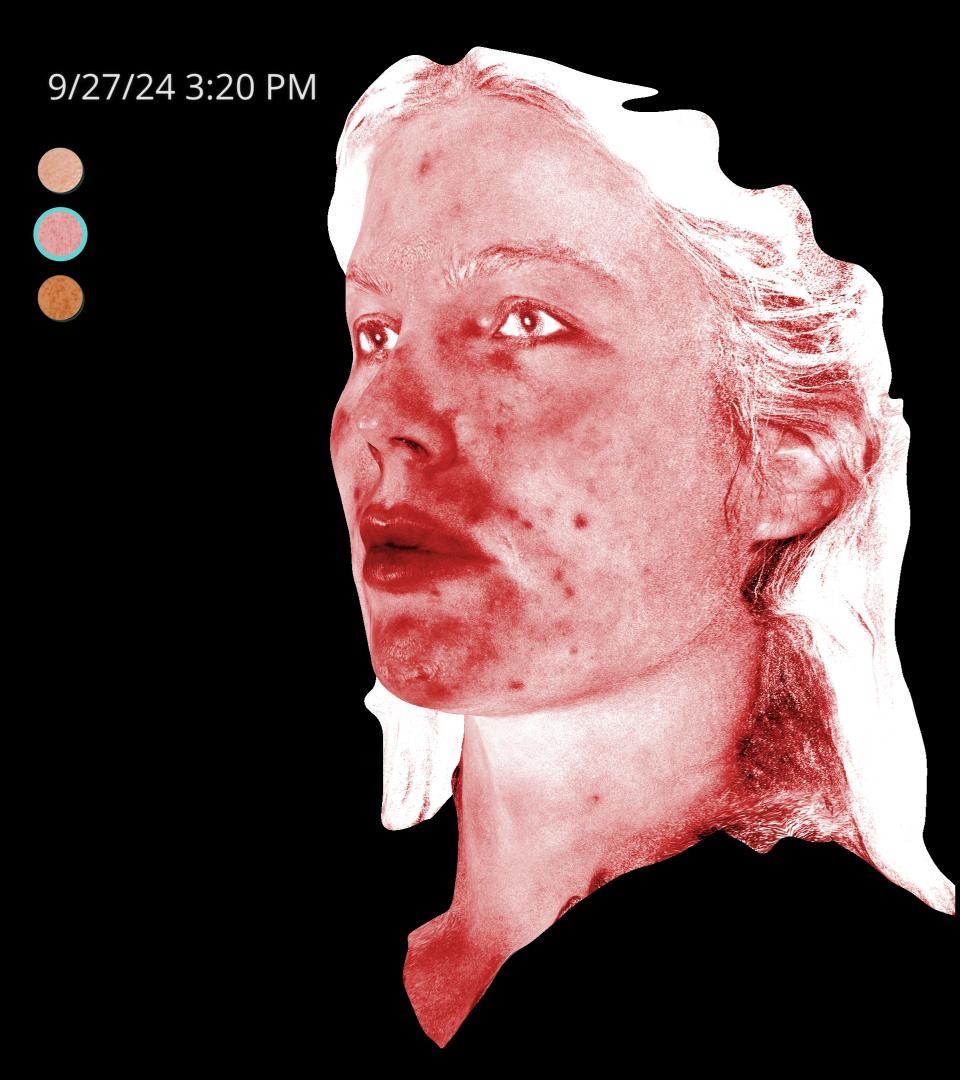 Before Image: Rosacea - left-front-oblique