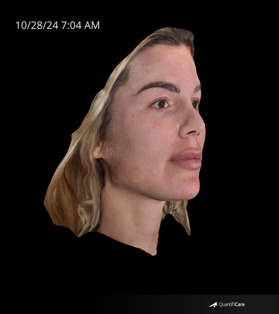 After Image: Rosacea - right-front-oblique