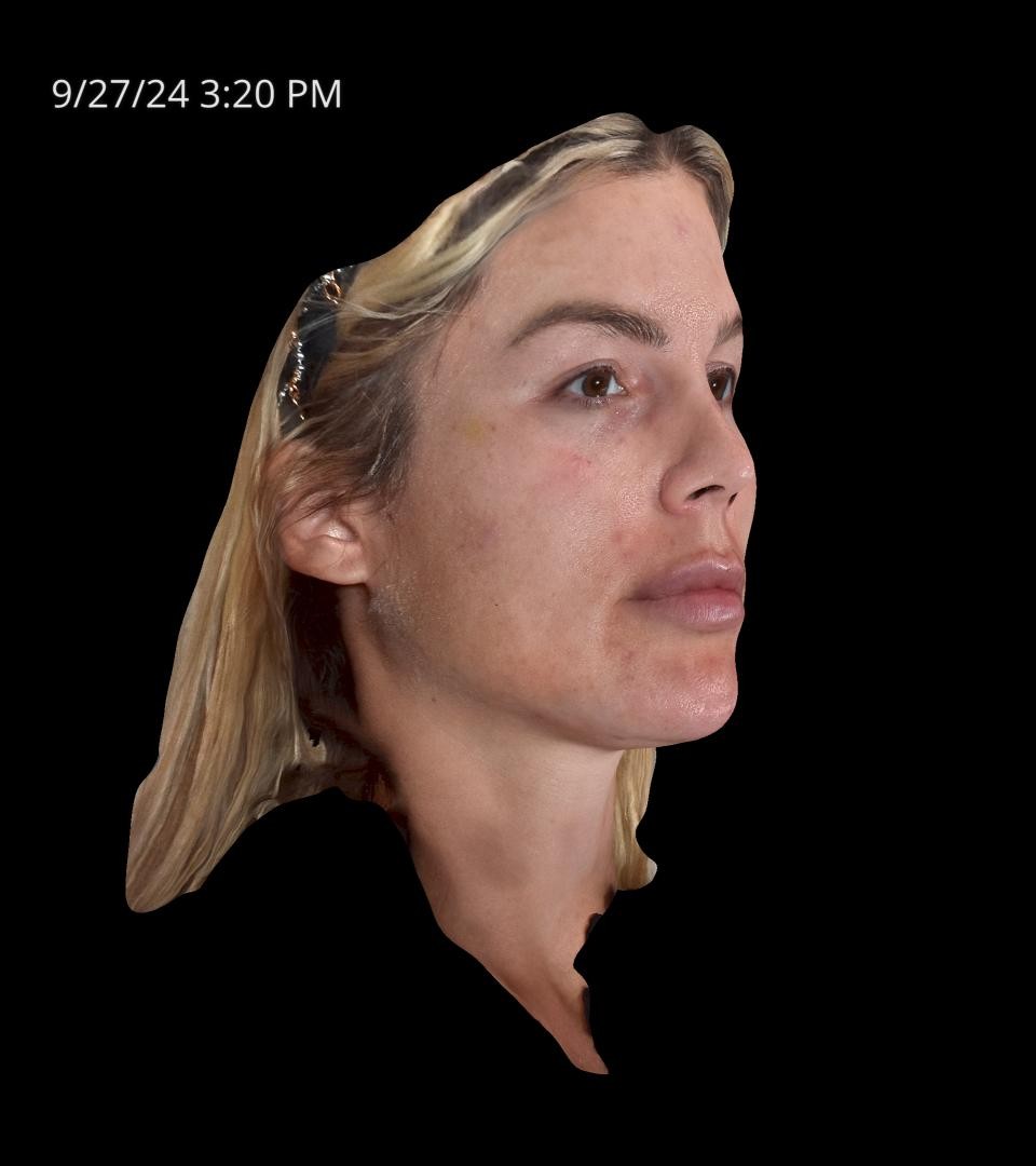 Before Image: Rosacea - right-front-oblique