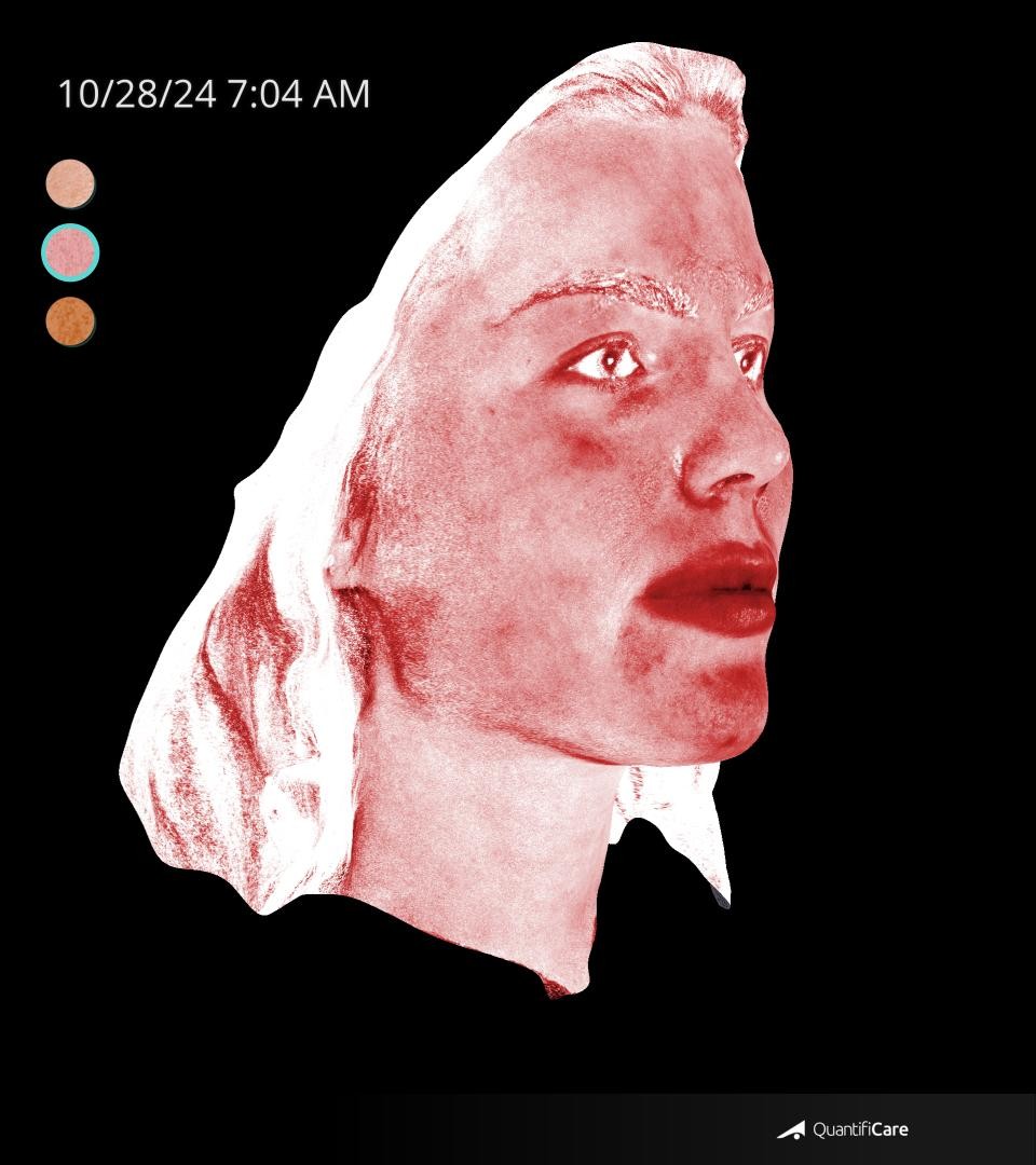 After Image: Rosacea - right-front-oblique