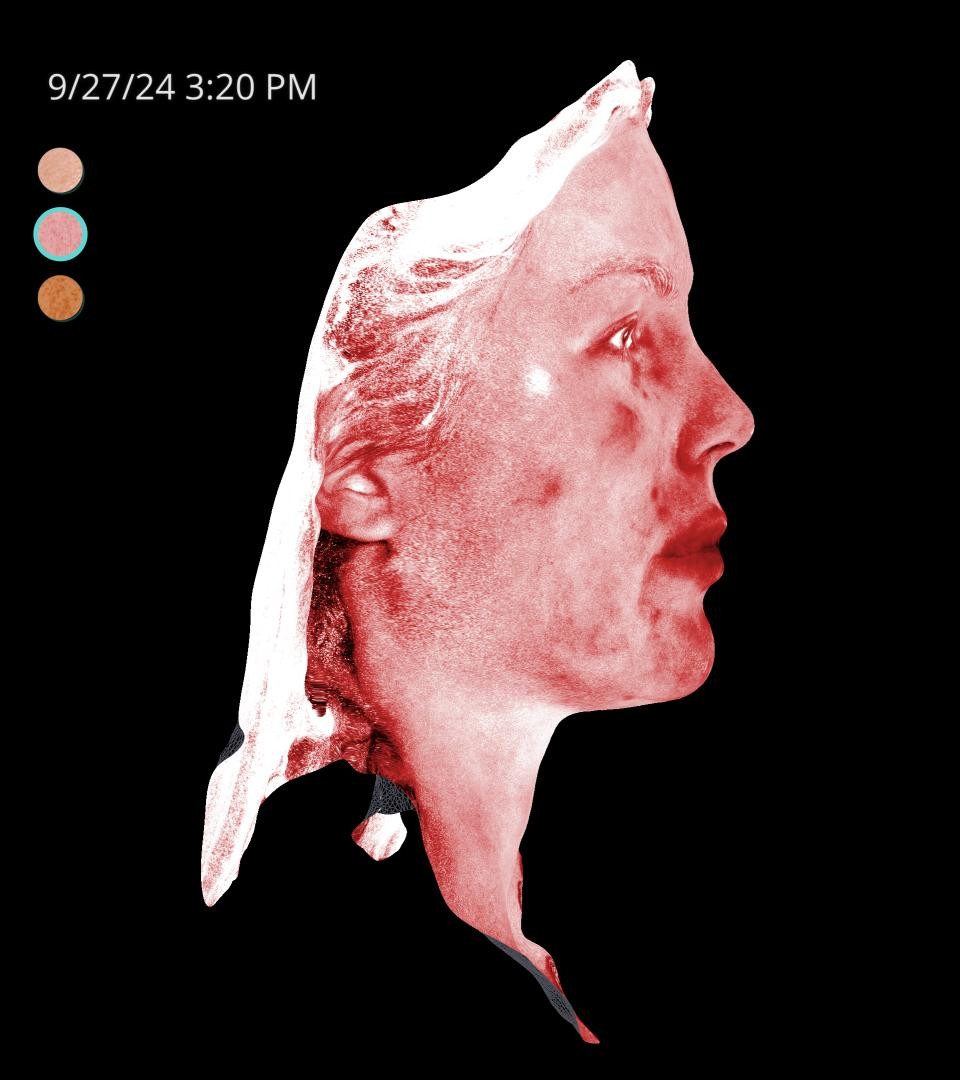 Before Image: Rosacea - right-side