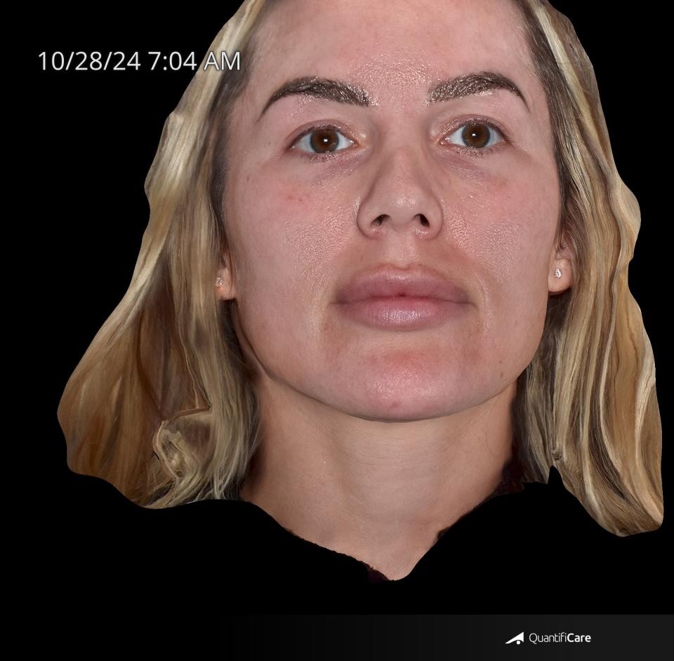 After Image: Rosacea - front