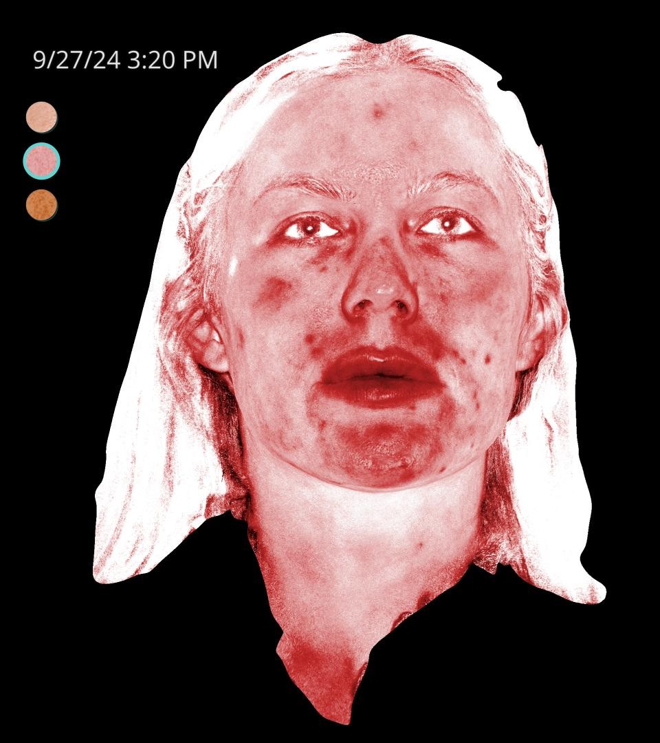Before Image: Rosacea - front