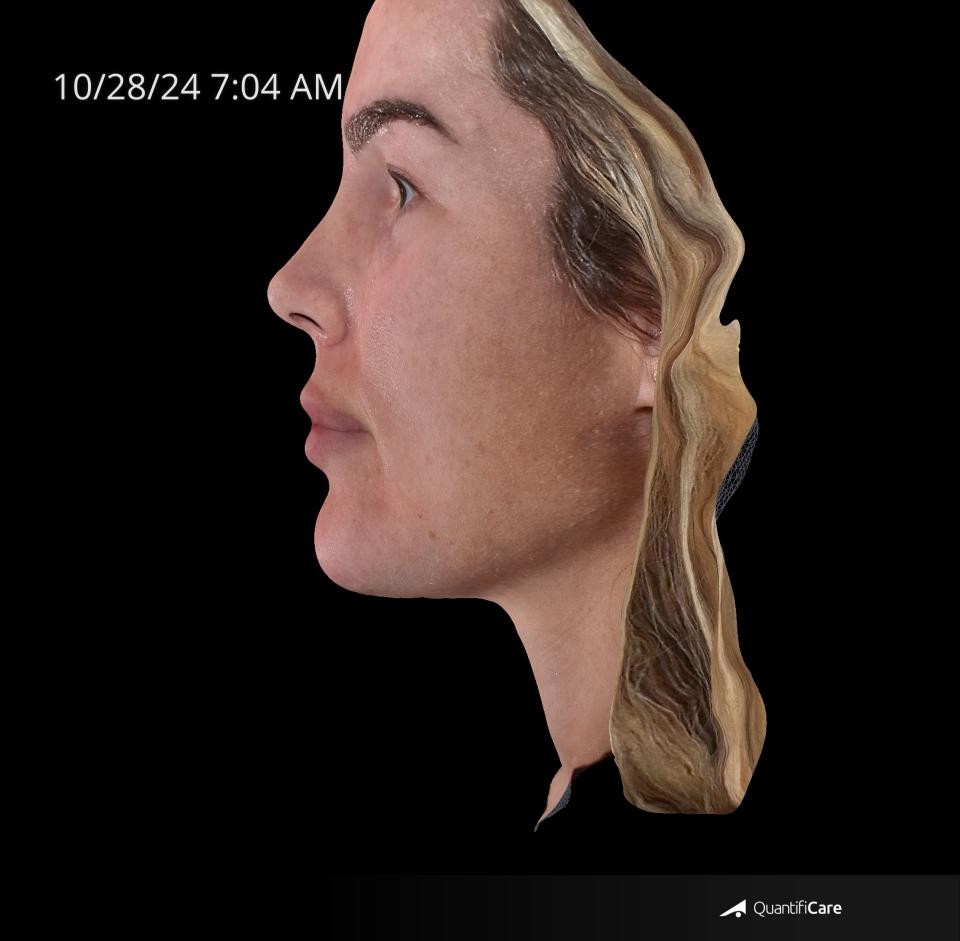 After Image: Rosacea - left-side