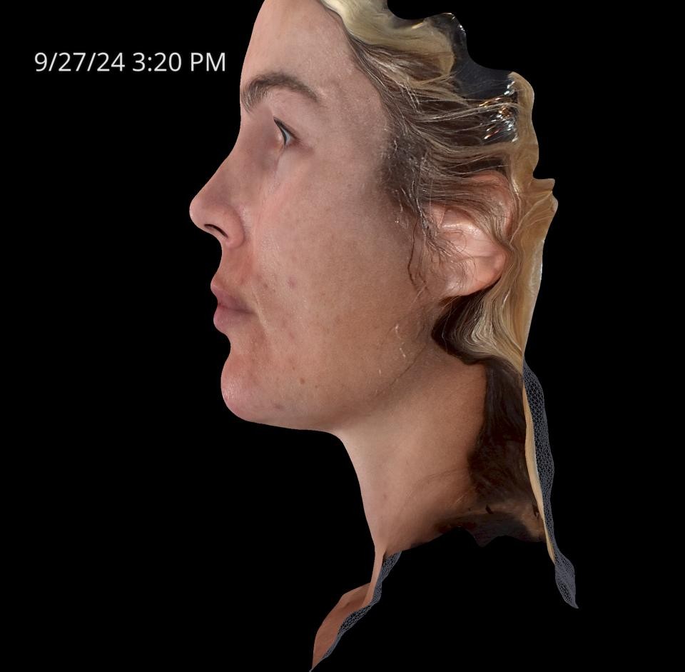 Before Image: Rosacea - left-side