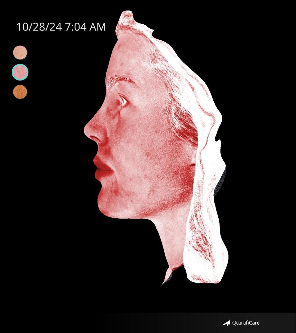 After Image: Rosacea - left-side