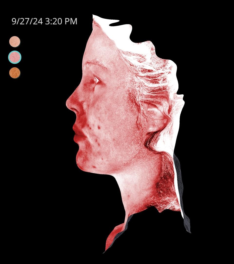 Before Image: Rosacea - left-side