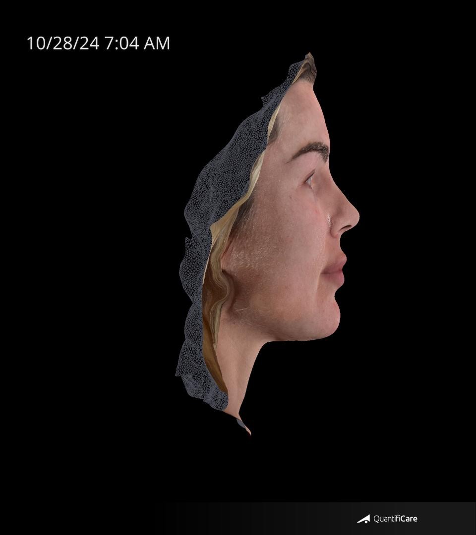 After Image: Rosacea - right-side