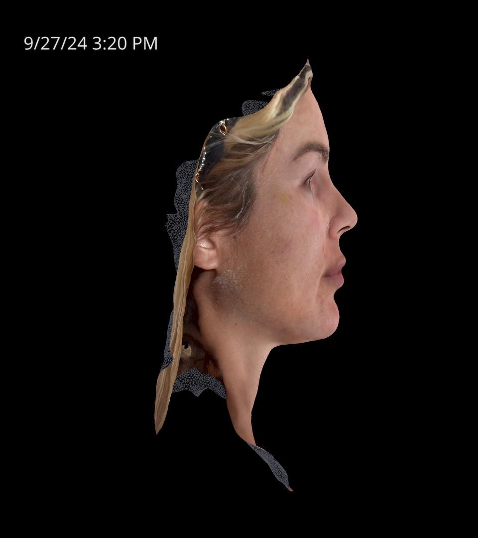 Before Image: Rosacea - right-side