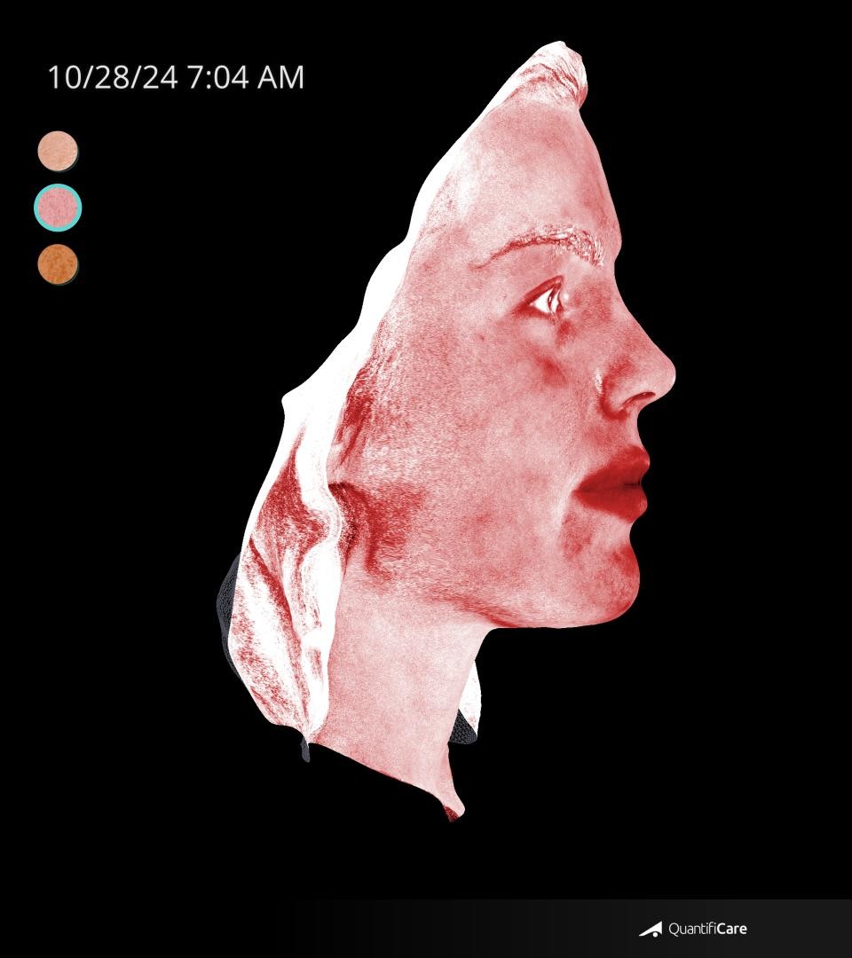 After Image: Rosacea - right-side