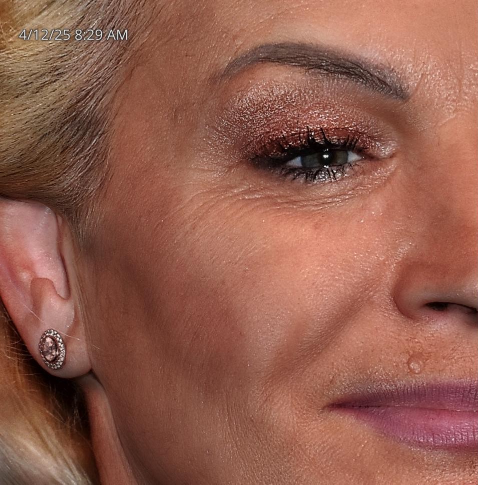 Before Image: Tattoo Removal - right-front-oblique